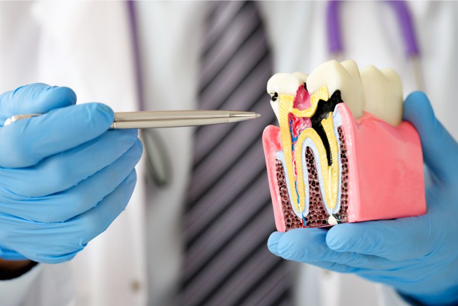 Diagram of tooth caries