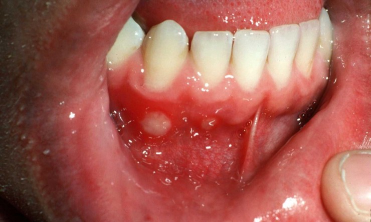 Mouth Ulcer Closeup