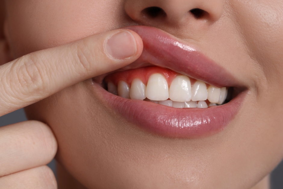 A woman showing off her gums