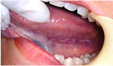 Woman with bluem oral gel in pocket to treat oral ulcers
