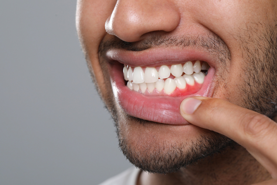 A man pulling down his lip to see the gumline