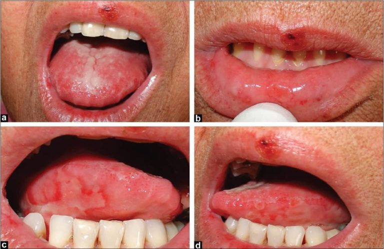 Cases of Oral Mucositis