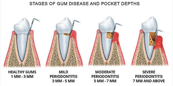 Diagram of periodontitis