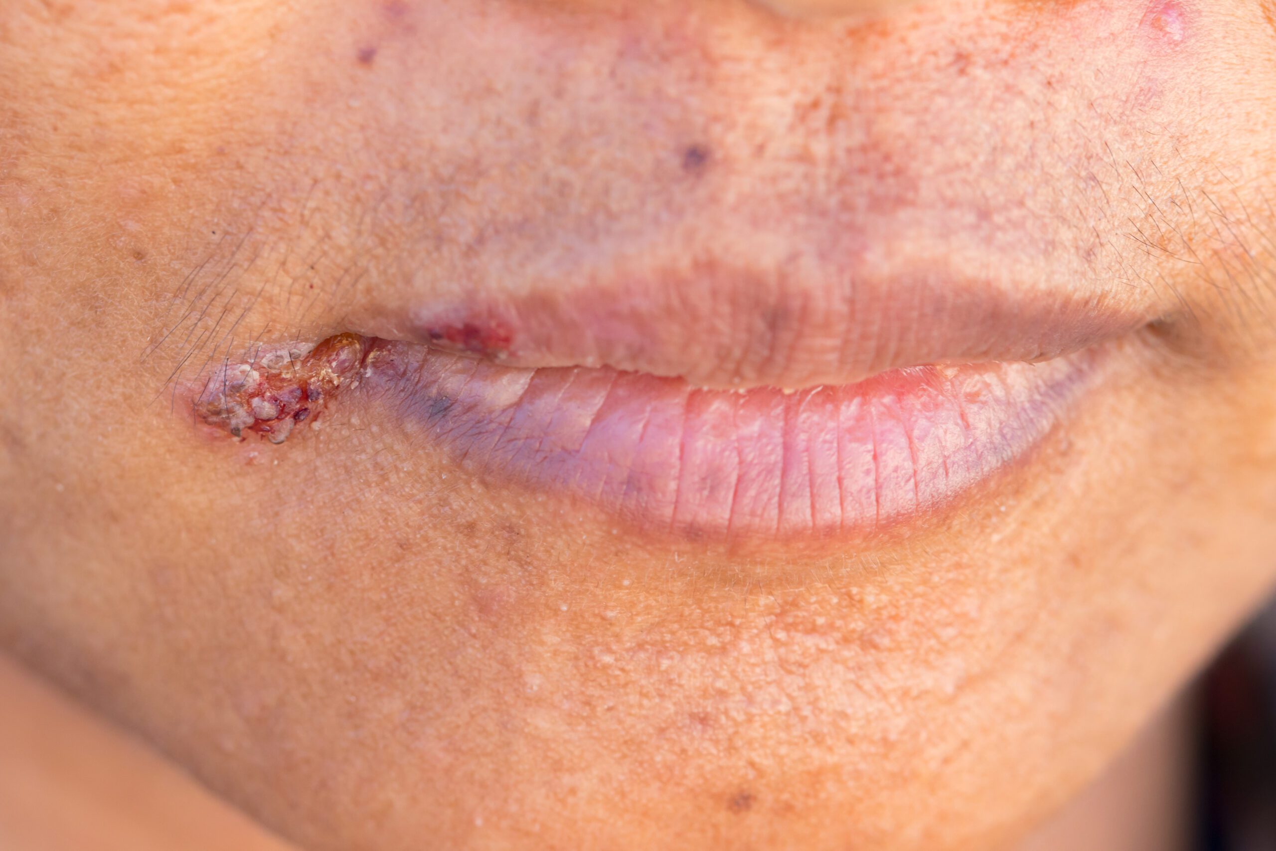 A case of angular cheilitis